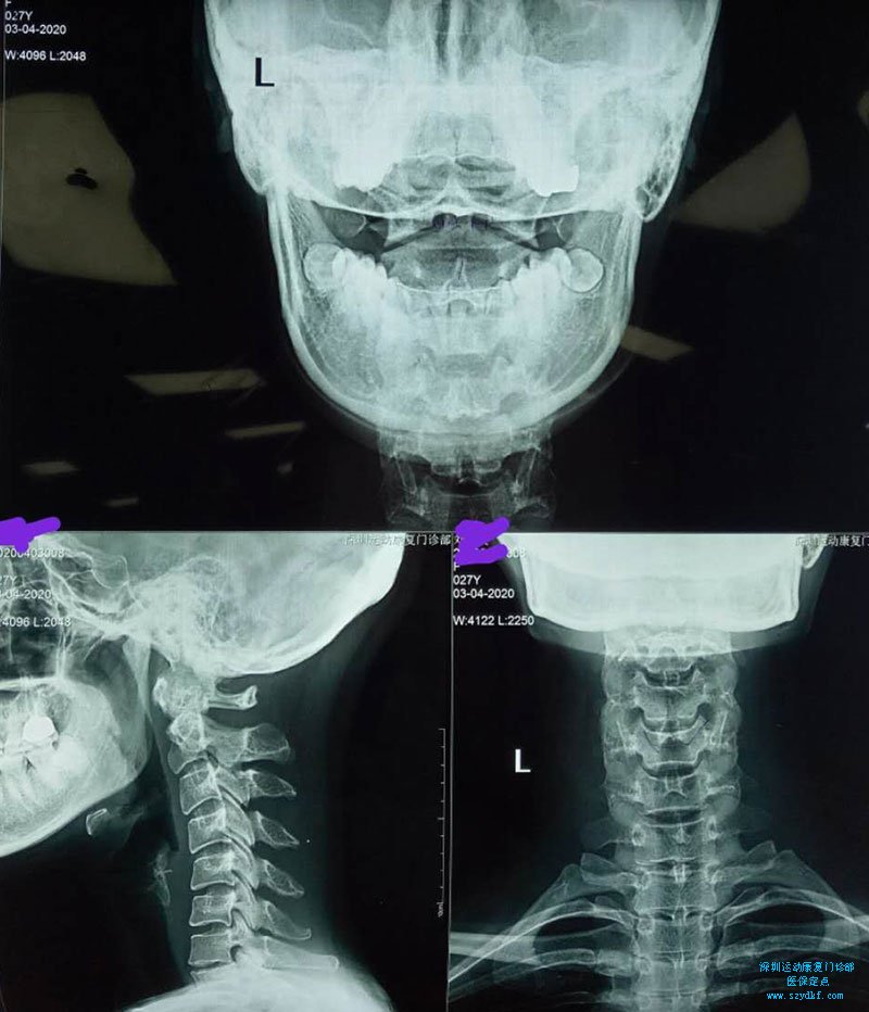 辅助检查：DR(2020.4.3门诊部):颈椎曲度反弓，寰枢关节左窄右宽。