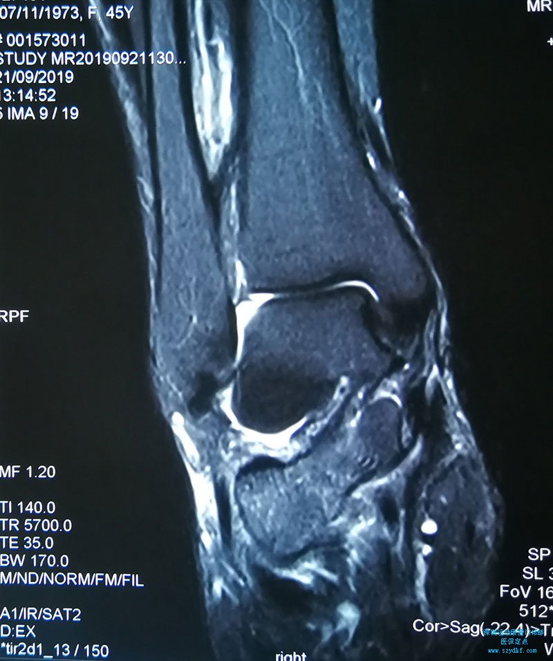 右踝外侧副韧带-距腓前、后韧带及内侧胫舟韧带部分损伤，跟腱部分损伤。