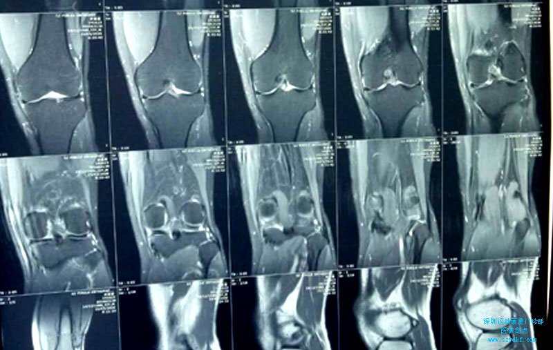 左膝关节内侧半月板损伤