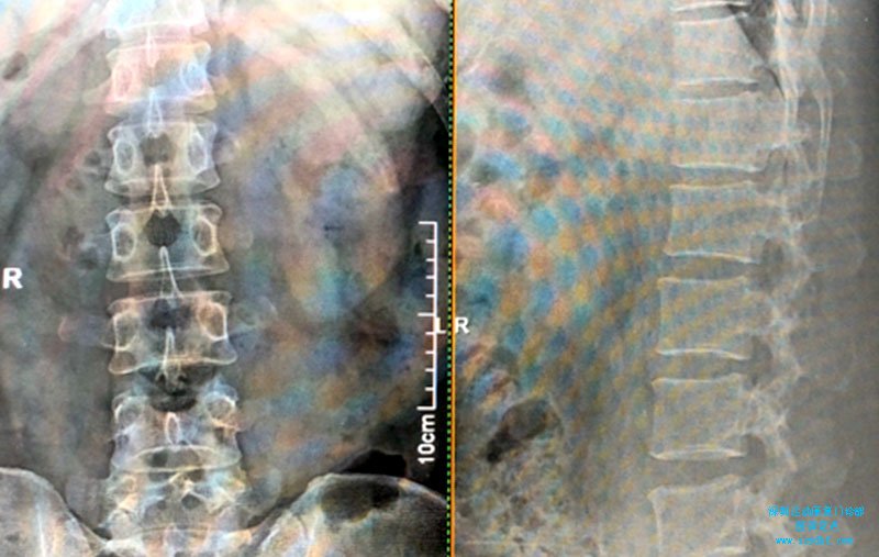 腰部活动受限腰骶关节压痛