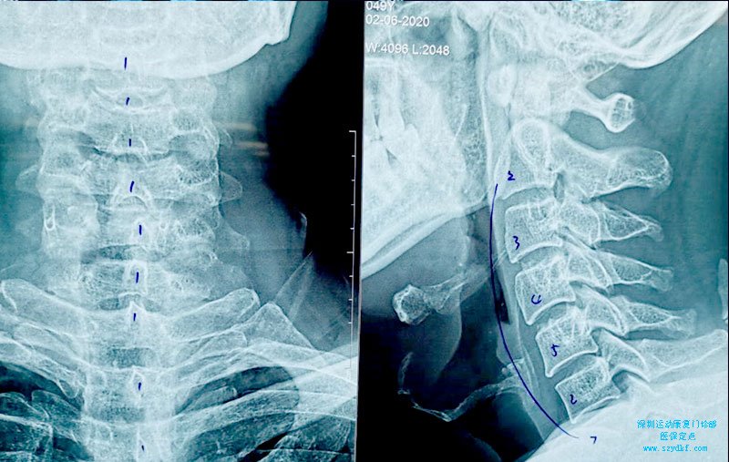项韧带和会厌骨钙化-颈椎病