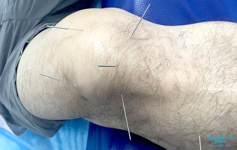 右膝关节髌尖末端病