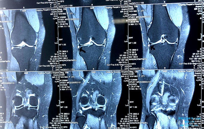 半月板损伤，右膝疼痛半年