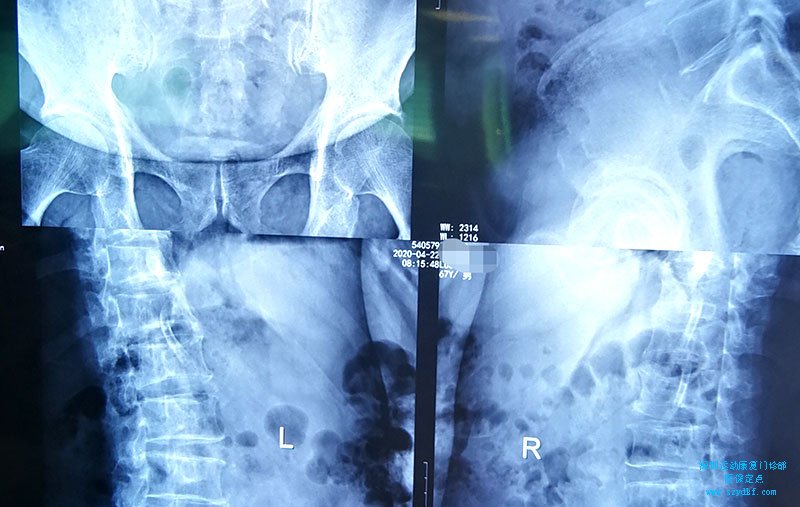 L4椎体前滑移-腰骶关节炎