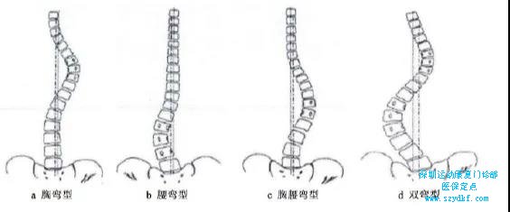 通常的脊柱侧弯分为如下四种情况：