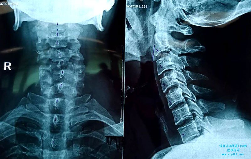 颈椎病椎间隙变小椎体往左侧偏斜