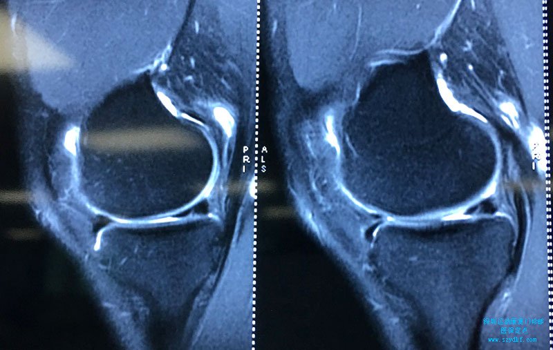 双膝关节内侧半月板损伤