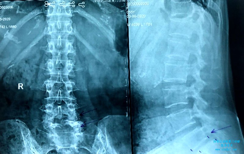 腰椎间盘突出症骶椎骨赘明显，S1向前滑移