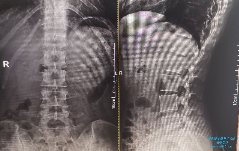 腰骶关节压痛棘旁压痛腰骶关节炎