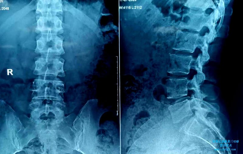 横突压痛、棘旁压痛腰骶关节炎