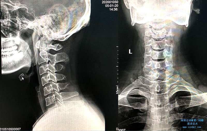 寰枢关节间隙稍变窄颈椎病