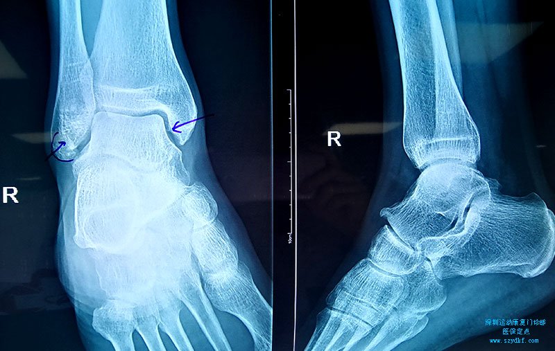 右踝疼痛3年右踝关节创伤性关节炎