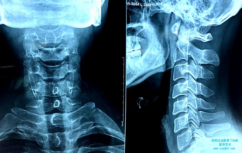 颈部生理弧度消失颈椎退行性改变-颈椎病