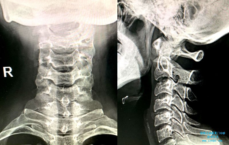 颈肩痛1月-颈椎病