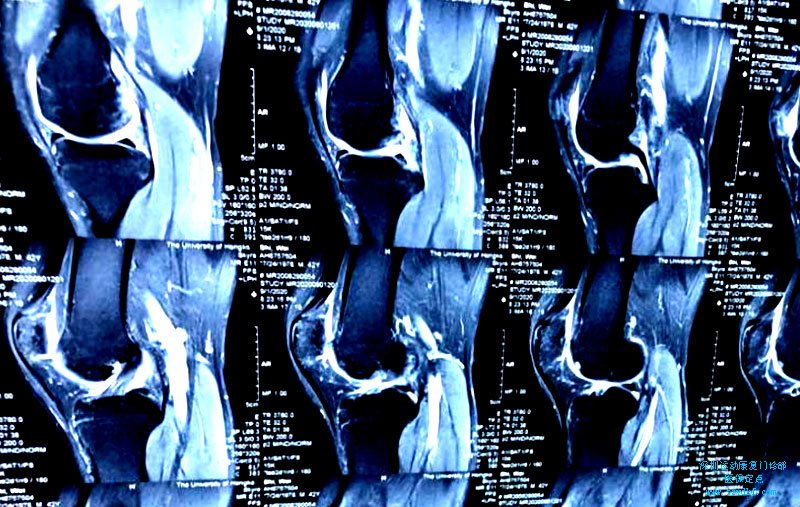 右膝疼痛伴功能障碍2月-髌骨软化症