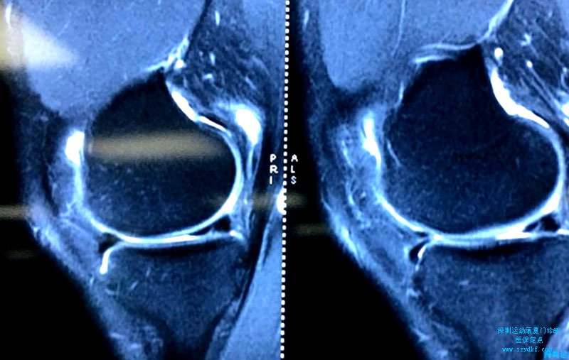双膝疼痛半年余-双膝内侧半月板损伤