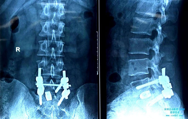 腰部反复疼痛1年-腰骶关节炎