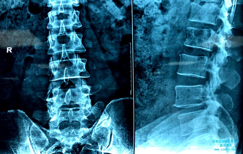 腰部疼痛伴左臀部疼痛2月腰椎间盘膨出症