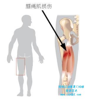 腘绳肌大腿后侧肌、起自坐骨结节，止於胫骨，跨越髋膝，作用为伸髋屈膝。是一组肌群而不是单独一块肌肉，通常由半腱、半膜肌和股二头肌三块肌肉组成。