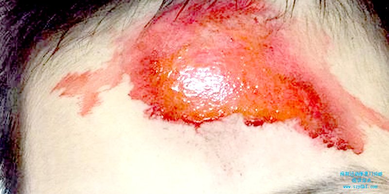 擦伤：即皮肤的表皮擦伤。如擦伤部位较浅