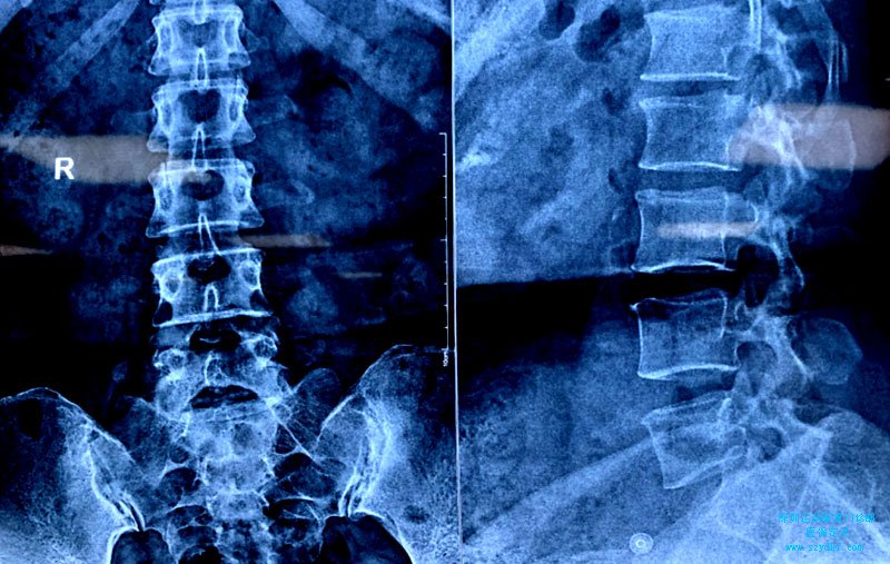 腰骶部疼痛-腰椎间盘突出症