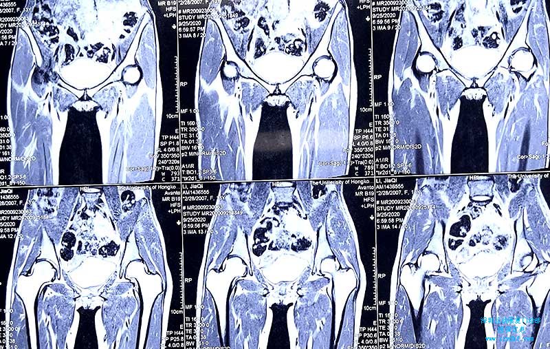 右髋疼痛-右髋关节炎