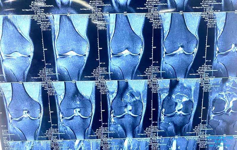 右膝髌尖末端压痛，抽屉试验(+-)，髌股关节内侧间隙压痛,，内侧麦氏征(+)。