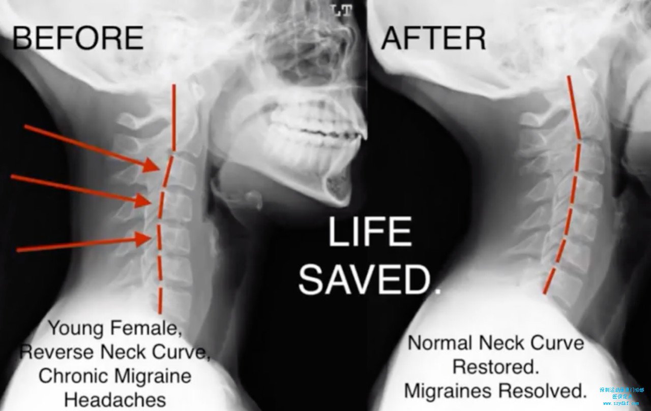 颈椎生理曲度也是可能恢复正常的