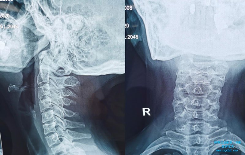 x光示：颈椎寰枢椎半脱位;椎体小关节紊乱;生理弧度改变