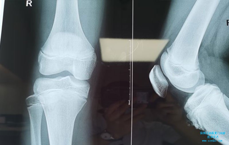 诊断：右膝胫骨结节骨骺炎