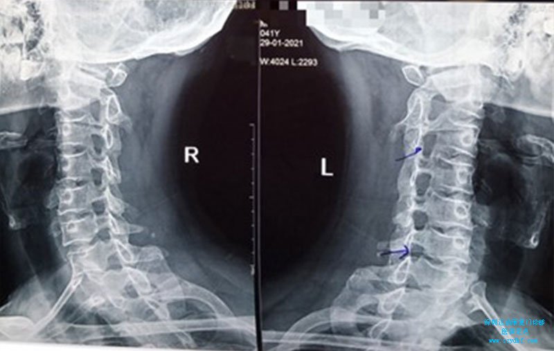 辅助检查：颈椎生理曲度变直，C3-C4、C6-7左侧椎间孔变窄。