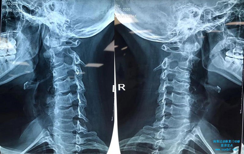 DR示：颈椎寰枢关节半脱位，生理曲度改变，反弓，C4-5/C5-6椎间孔狭窄
