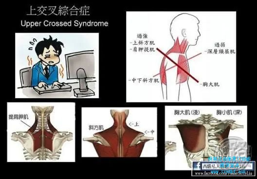 背后下部和颈前上部肌肉被拉长及软弱