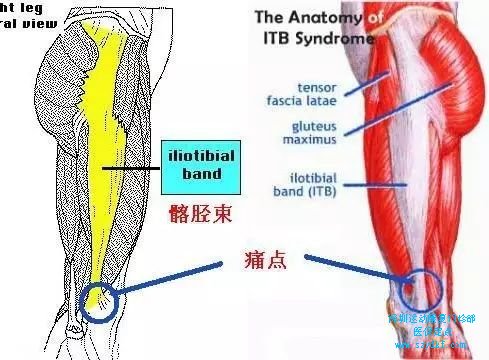 髂胫束综合征