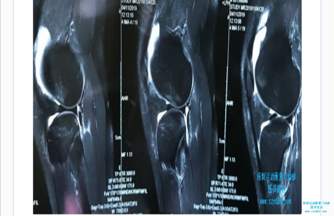 右膝关节前叉韧带重建术后