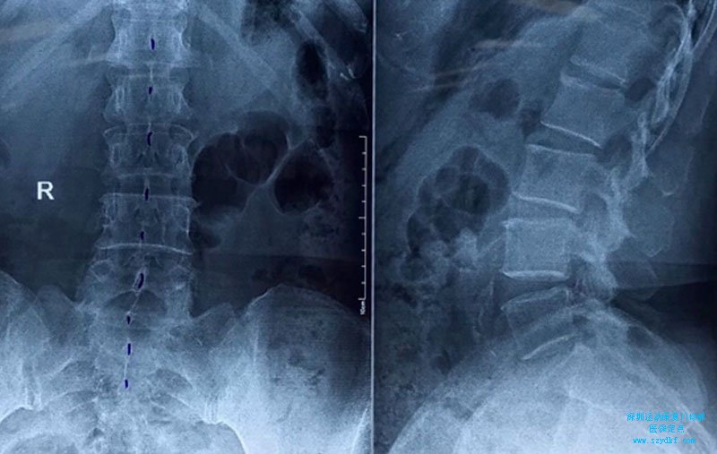 诊断：第三腰椎横突综合征