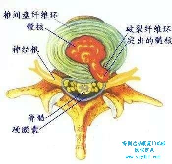 颈椎间盘退行性改变