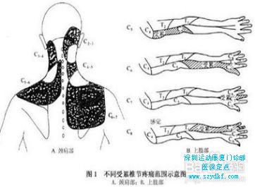 神经根型颈椎病的临床表现